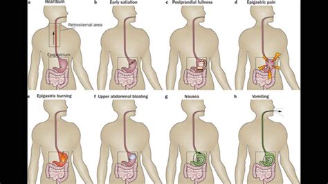 Dyspepsia and Surgery - YouTube