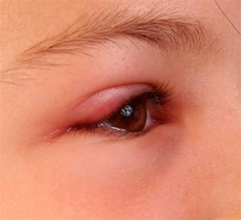 Swollen Eyelid - Symptoms, Treatment, Pictures, Causes | HubPages