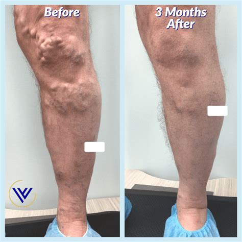 How Long is the Recovery Period After Varicose Vein Treatment? : Center ...