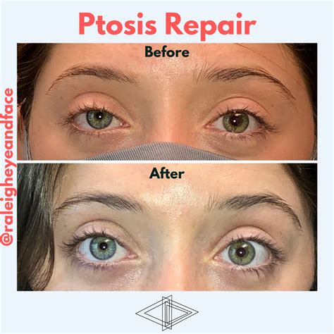 Ptosis Repair - Raleigh Eye and Face Plastic Surgery