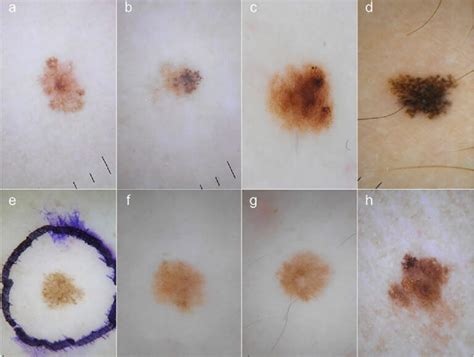 Melanoma photos early stage | Symptoms and pictures