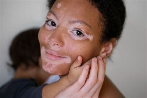 Vitiligo – Symptoms, Causes, & Treatment