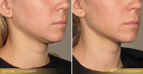 "Transform Your Skin: Unveiling the Magic of Ultherapy Treatment ...