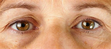 Do You Have Raccoon Eyes? What Causes Them and How to Fix It - Costhetics