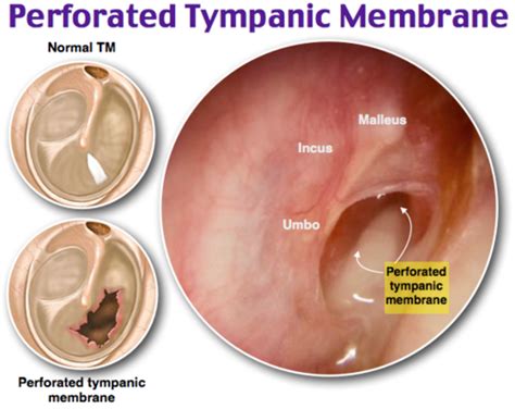 Tympanic Membrane Perforation (1B) Flashcards | Quizlet