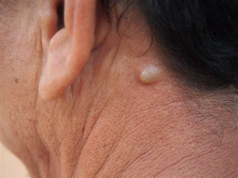 Lump Behind My Ear: What Do I Need to Know? | LifeMD