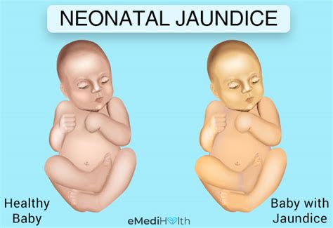 what is jaundice in babies mean - Laci Camp