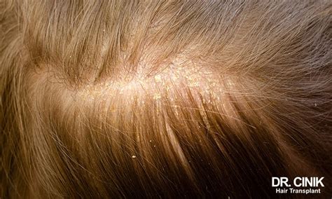 Scabs And Soreness on the Scalp: 11+1 Reasons