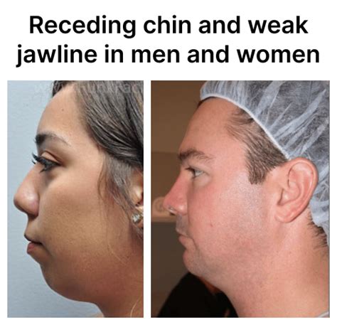 How to Fix Weak, Soft Jawline and Receding Chin with Mewing (2023)