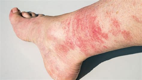 Diabetic Sores on Legs: Causes, Diagnosis, and Prevention Tips