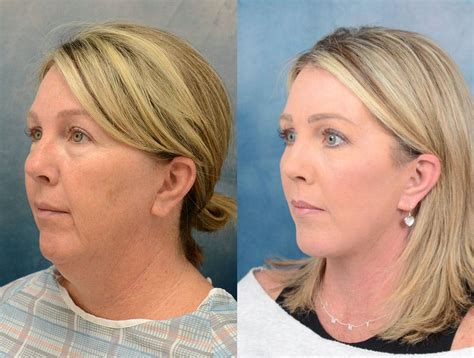 Facelift Recovery Guide - Abstra Kraft