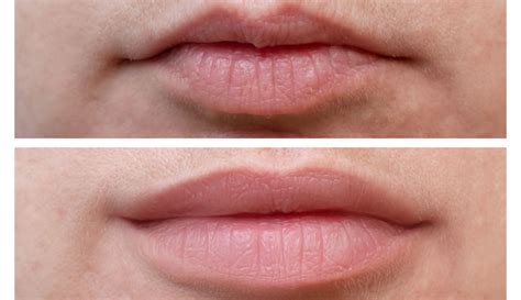 Botox Lip Flip Before and After: What is a Lip Flip and Who Needs It ...