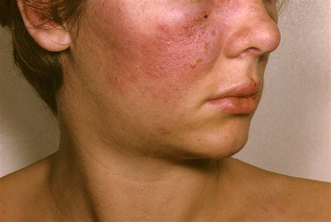 Risk of Systemic Lupus Erythematosus in Patients With Idiopathic ...