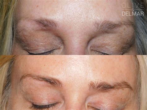 neuLASH and neuBROW Before and After | LovelySkin