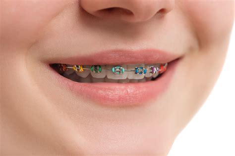 How Much Are Braces For Adults Top Teeth Only at Mable Bryant blog