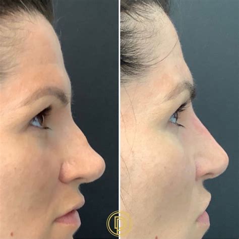 Non Surgical Nose Job Dallas | Liquid Nose Job | Liquid Rhinoplasty