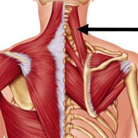 Trigger Point Therapy - Levator Scapulae Taping Procedure | Levator ...