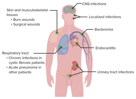 Pseudomonas | Concise Medical Knowledge