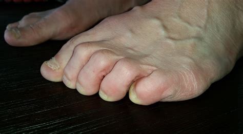 Toe Deformities – Foot Surgery London