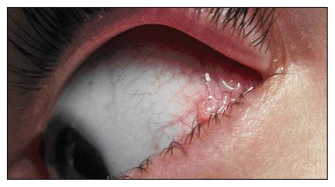 Chronic symptomatic and microfilaremic loiasis in a returned traveller ...