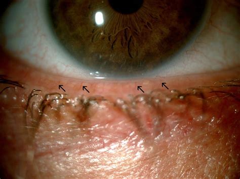 Meibomian Gland Dysfunction and Treatment - American Association for ...