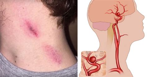 17-Year-Old Boy Dies From Seizure After THESE Marks Form On His Neck ...