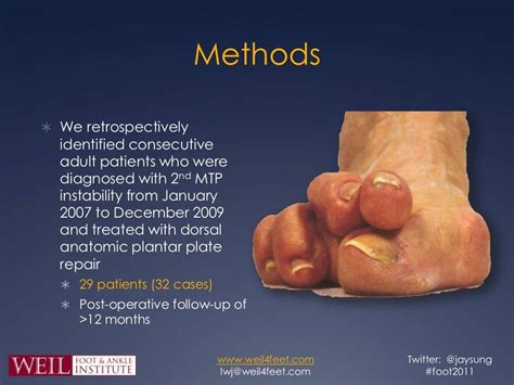 Dorsal Anatomic Plantar Plate Repair