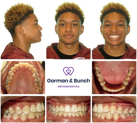 Invisalign Before And After Crowding