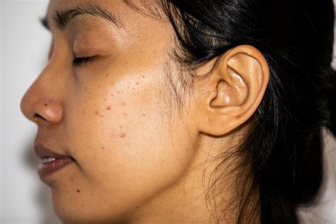 How Acne Causes Hyperpigmentation: Prevention, Treatments, Remedies