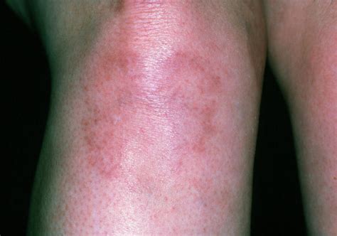 Systemic Lupus Erythematosus Rash On Woman's Leg Photograph by Dr P ...