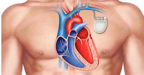 Pacemaker implantation starts at Anantnag’s hospital - The Legitimate