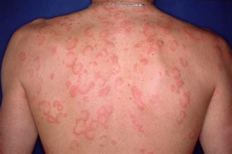 Cetirizine Provides More Benefits for Acute Urticaria Than ...