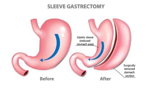 Gastric Sleeve Surgery In Huntsville, AL | Starting At $9,500!