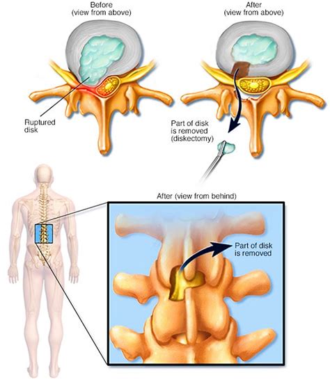 Laminectomy Surgery - Recovery & Laminectomy Complications