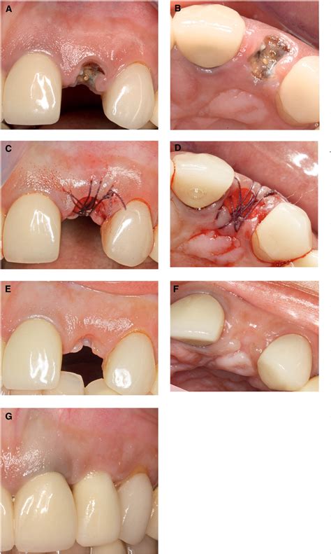 Table 1 from Histologic analysis of healing after tooth extraction with ...