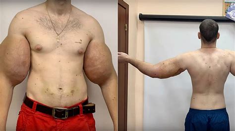 Russian 'Popeye' has 3 pounds of 'dead' muscle removed after DIY ...