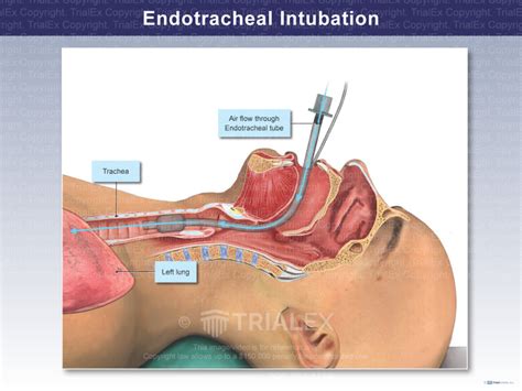 Endotracheal Intubation - TrialQuest Inc.