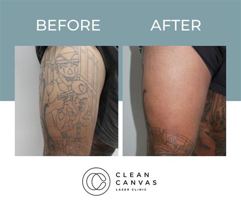 Tattoo Removal Prices In Sydney - Clean Canvas Laser Clinic