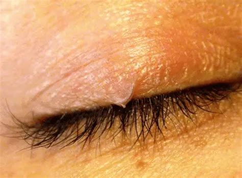 25 Fresh Eyebrow Mites Treatment - Demodectic Mange