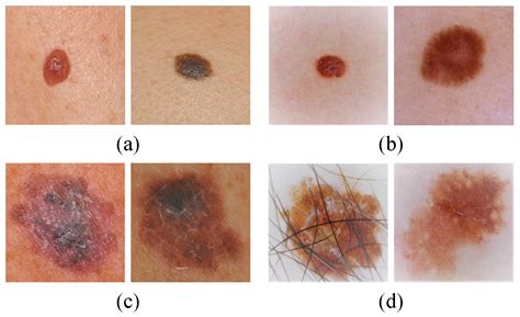 Melanoma Skin Cancer Stages