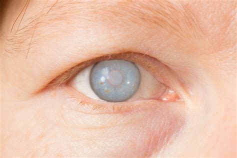 A brief about different types of Cataracts - Global Eye Hospital