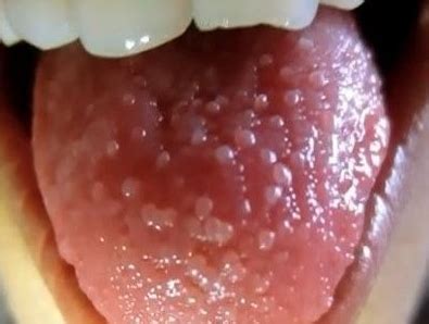 Swollen Taste Buds: on Tongue, Causes, Tip, Back, How to Get Rid ...