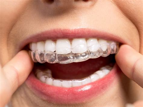 How are Invisalign attachments removed?