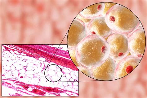 Where does fat go when we lose weight? Do fat cells disappear?