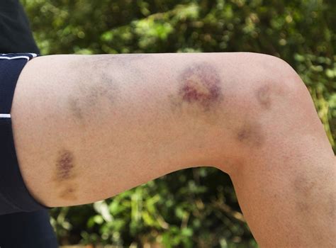 World Haemophilia Day: Parents 'avoid reporting strange bruises to ...