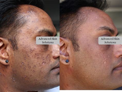 Acne - Advanced Skin Solutions