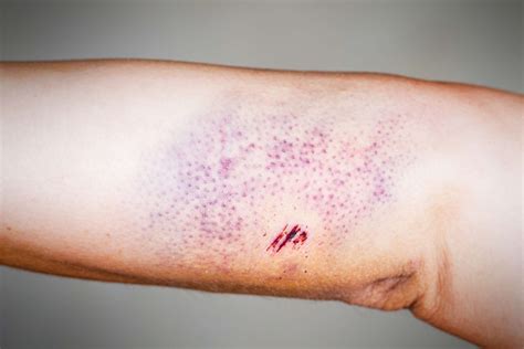 Petechiae vs. Purpura: Skin Discoloration and Your Health