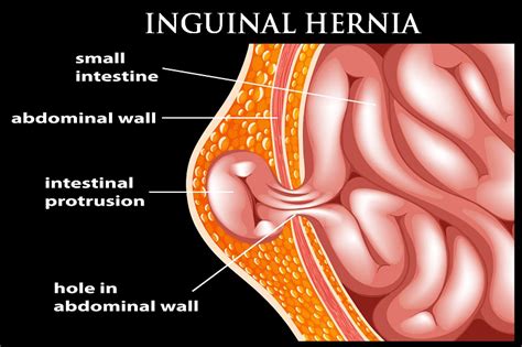 10 Surprising Symptoms of Inguinal Hernia | Dr. Abhijit Gotkhinde