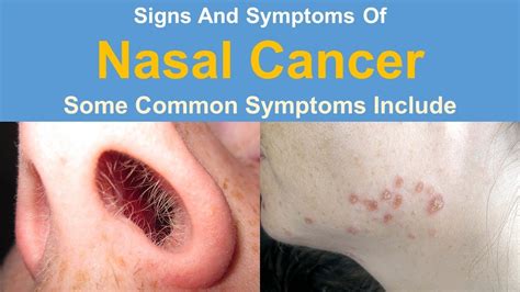 Signs And Symptoms Of Nasal Cancer - YouTube