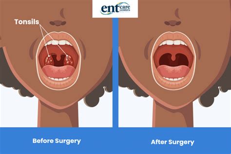 Pediatric Tonsillectomy And Adenoidectomy OpenAnesthesia, 52% OFF